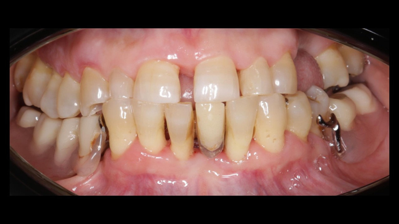 Exodoncia dientes inferiores + IOI (5)